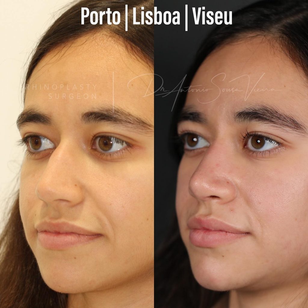 rinoplastia antes e depois