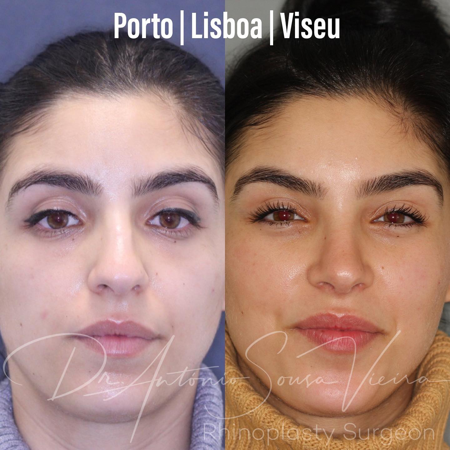 rinoplastia antes e depois