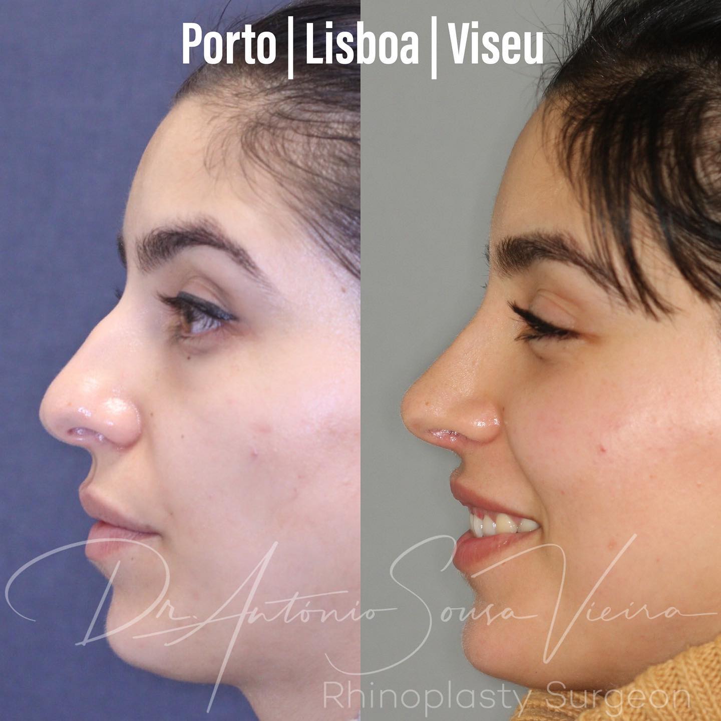 rinoplastia