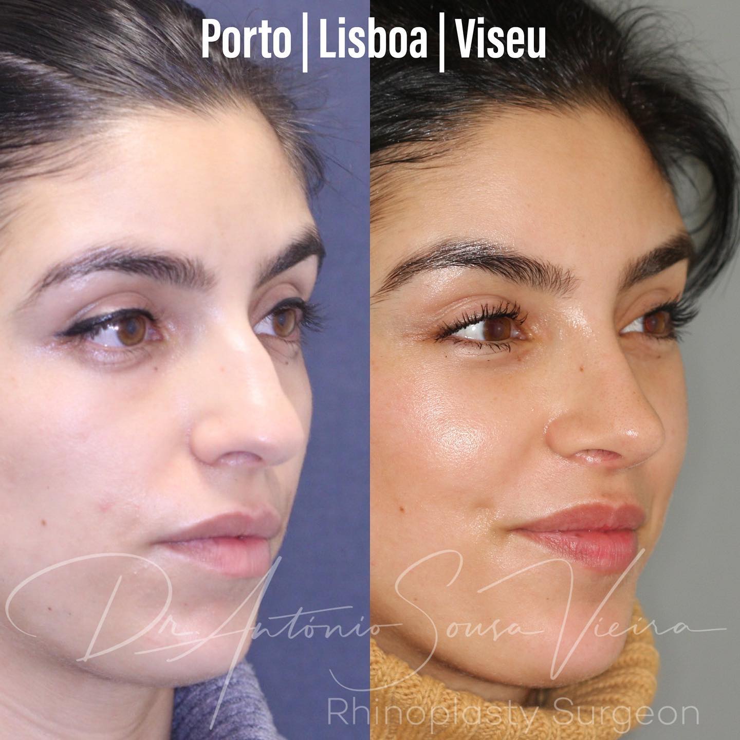 rinoplastia