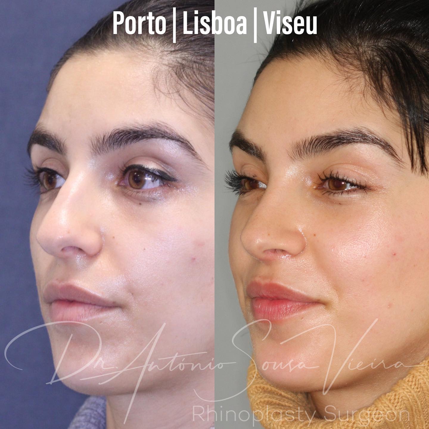 rinoplastia