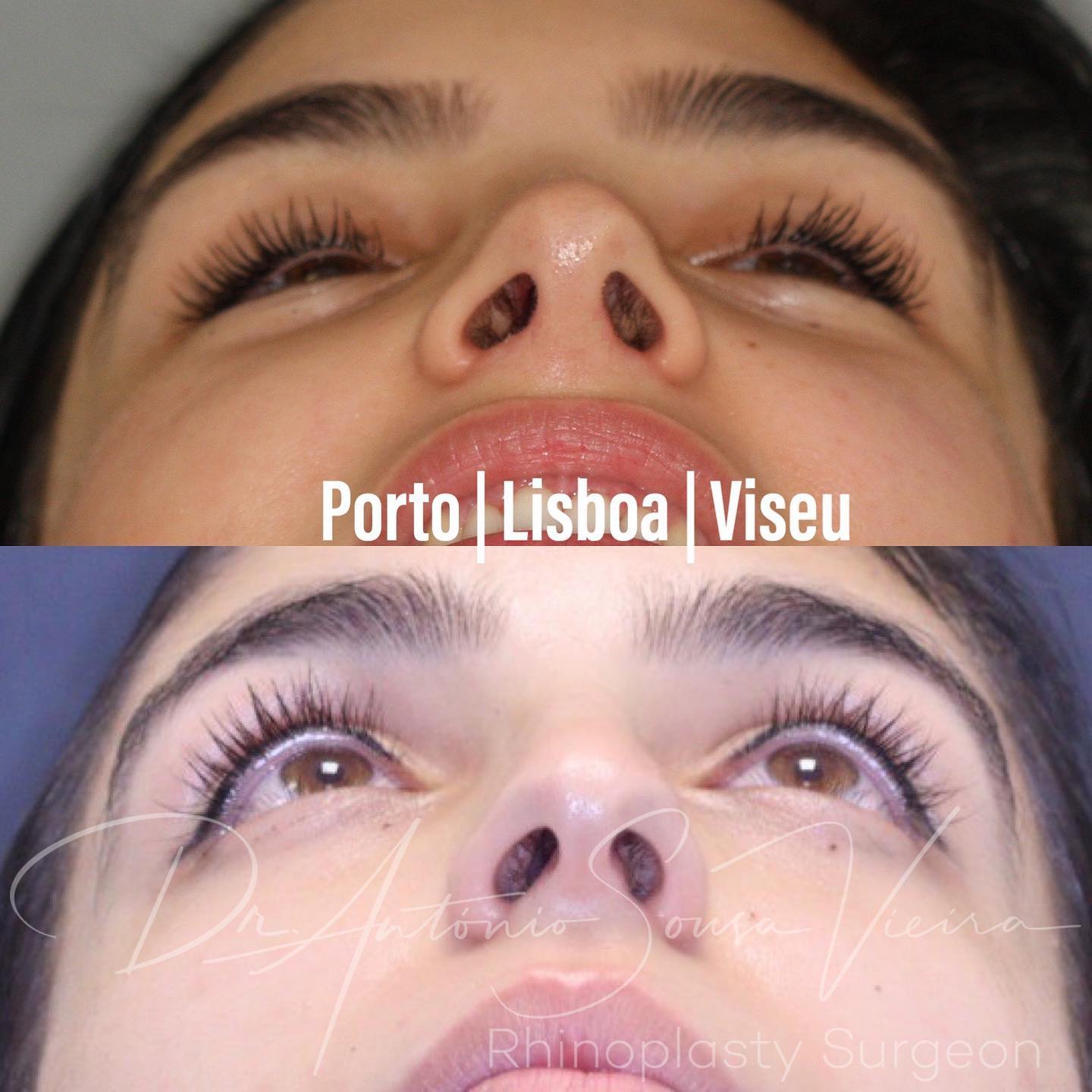 rinoplastia antes e depois