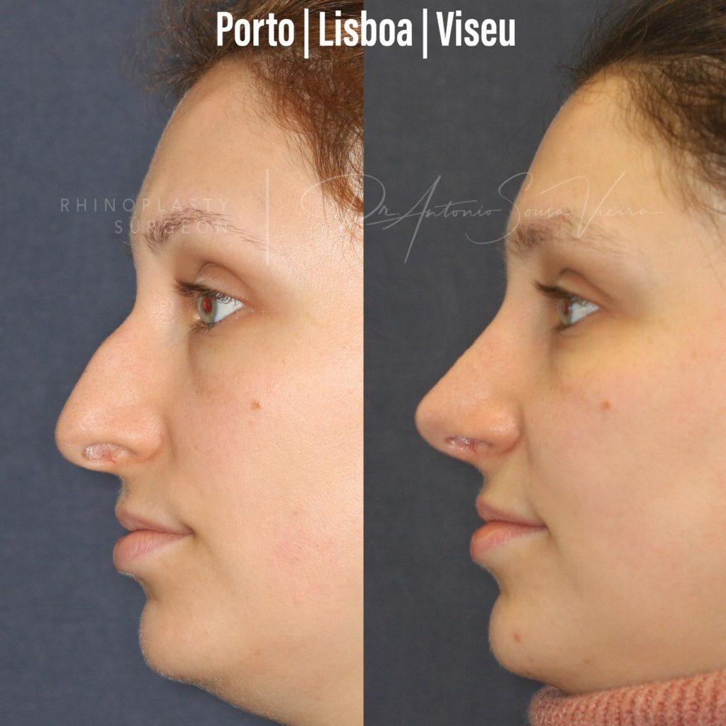 rinoplastia antes e depois