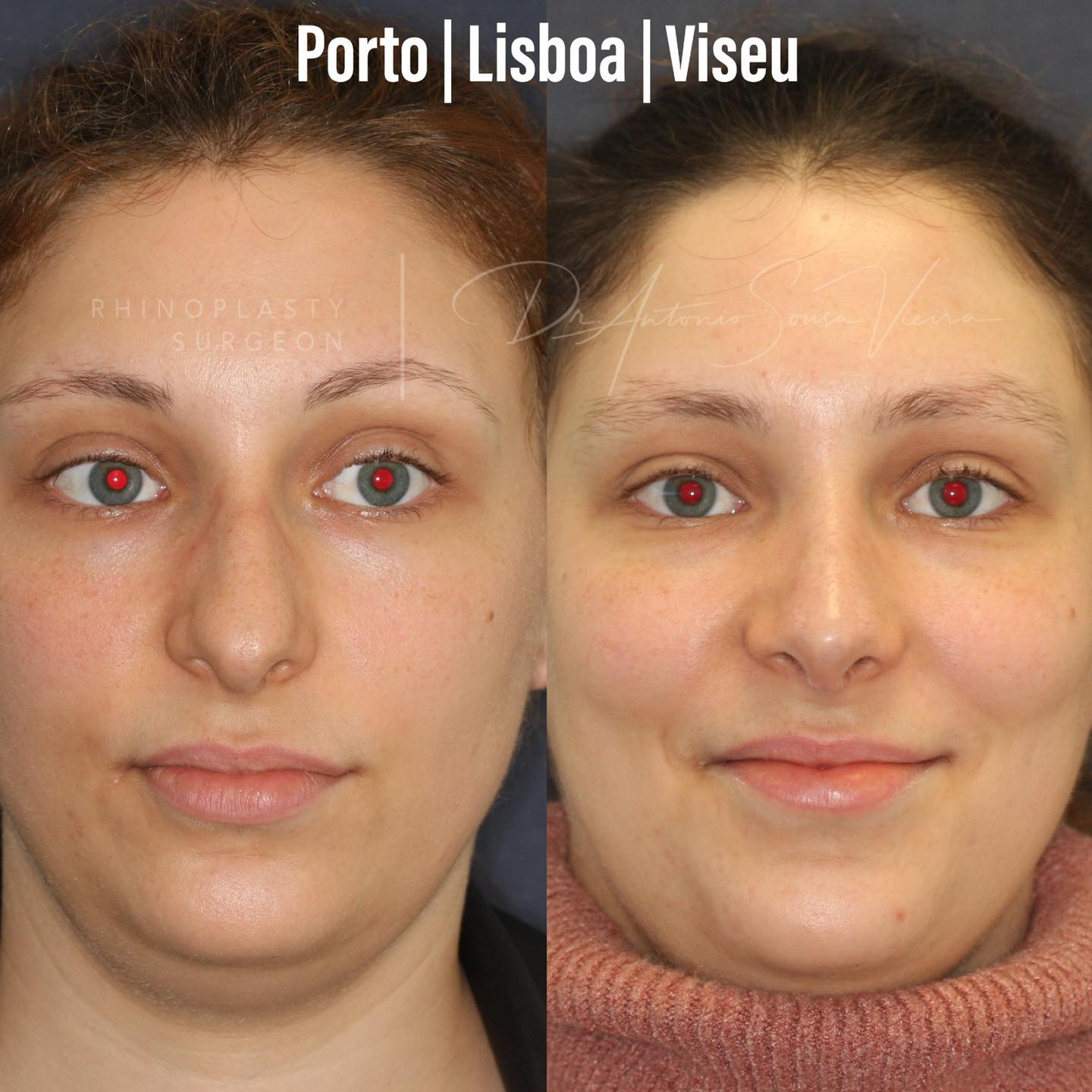 rinoplastia antes e depois
