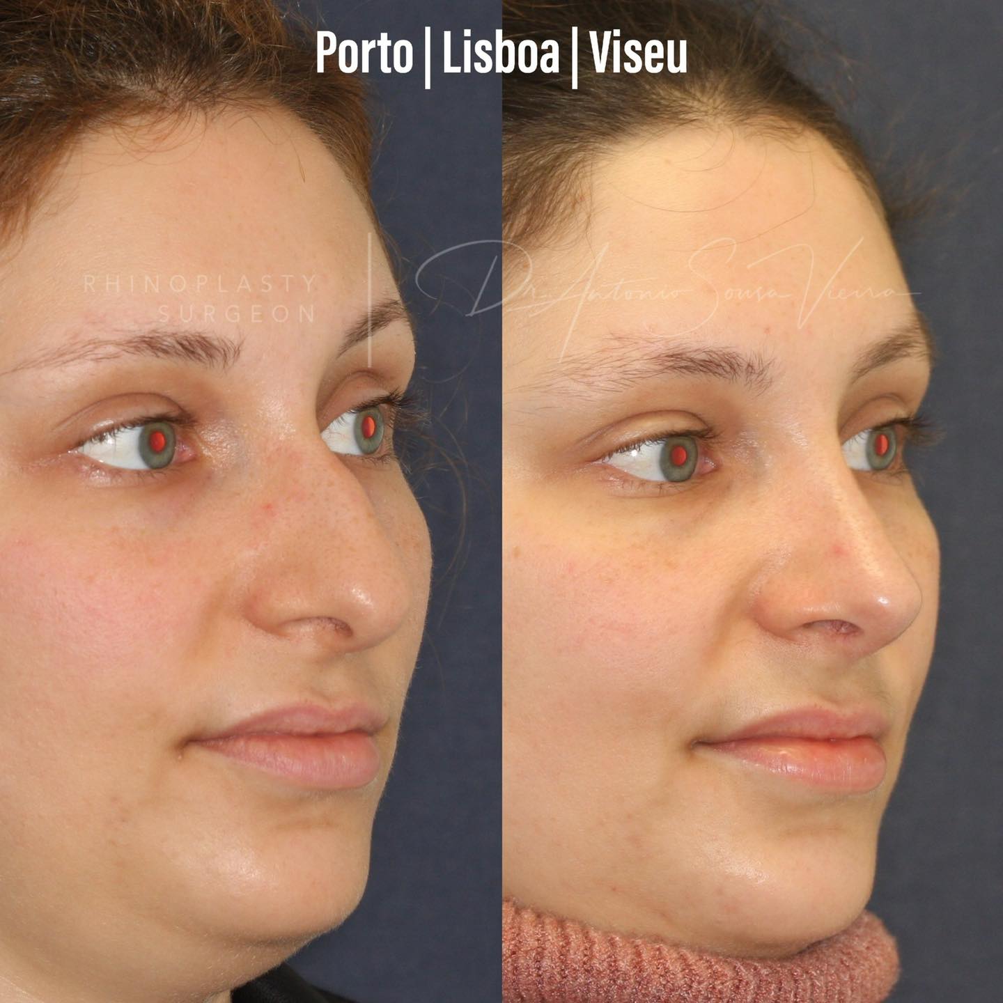 rinoplastia antes e depois