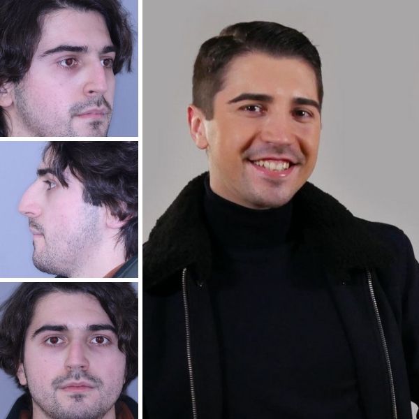 rinoplastia antes e depois