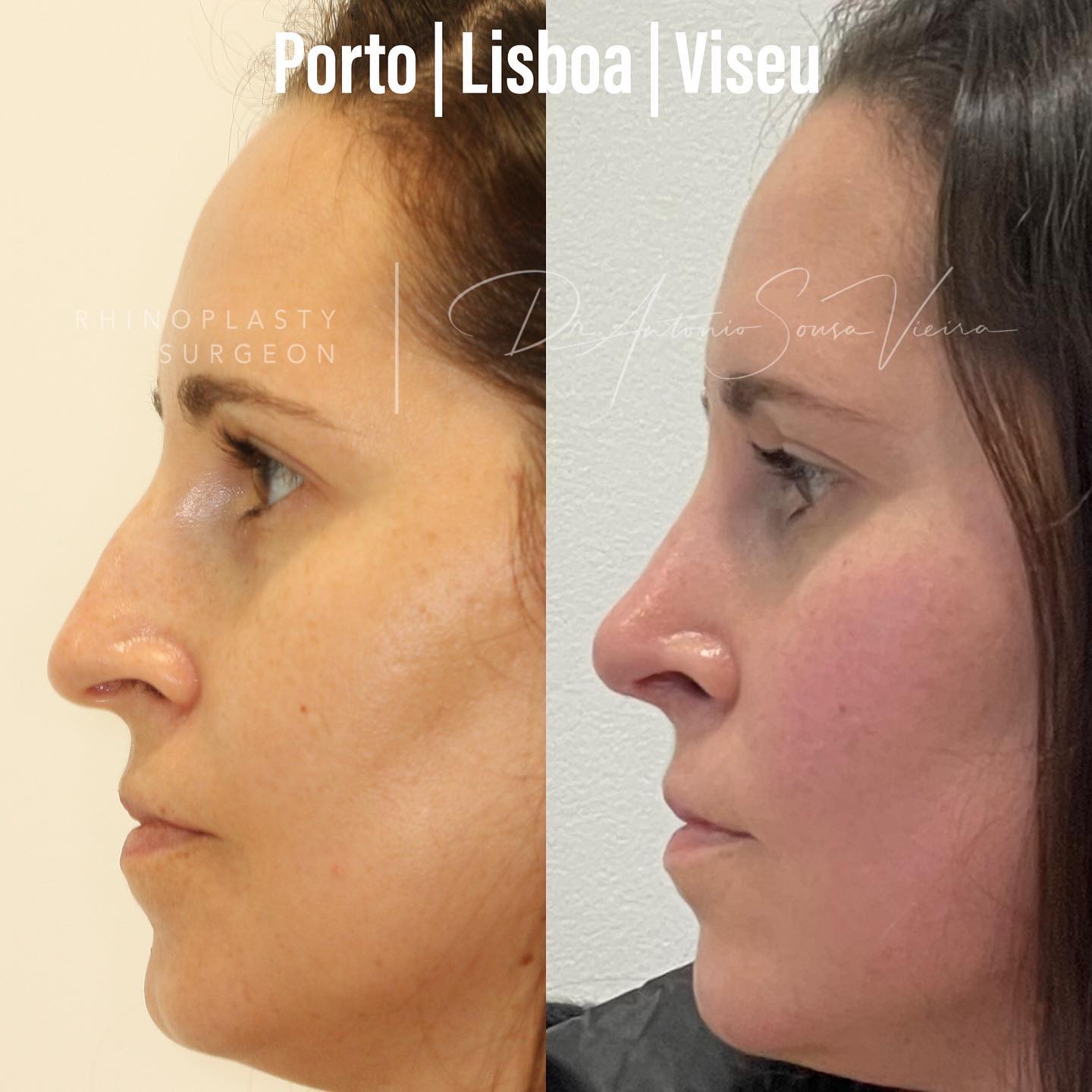 rinoplastia antes e depois