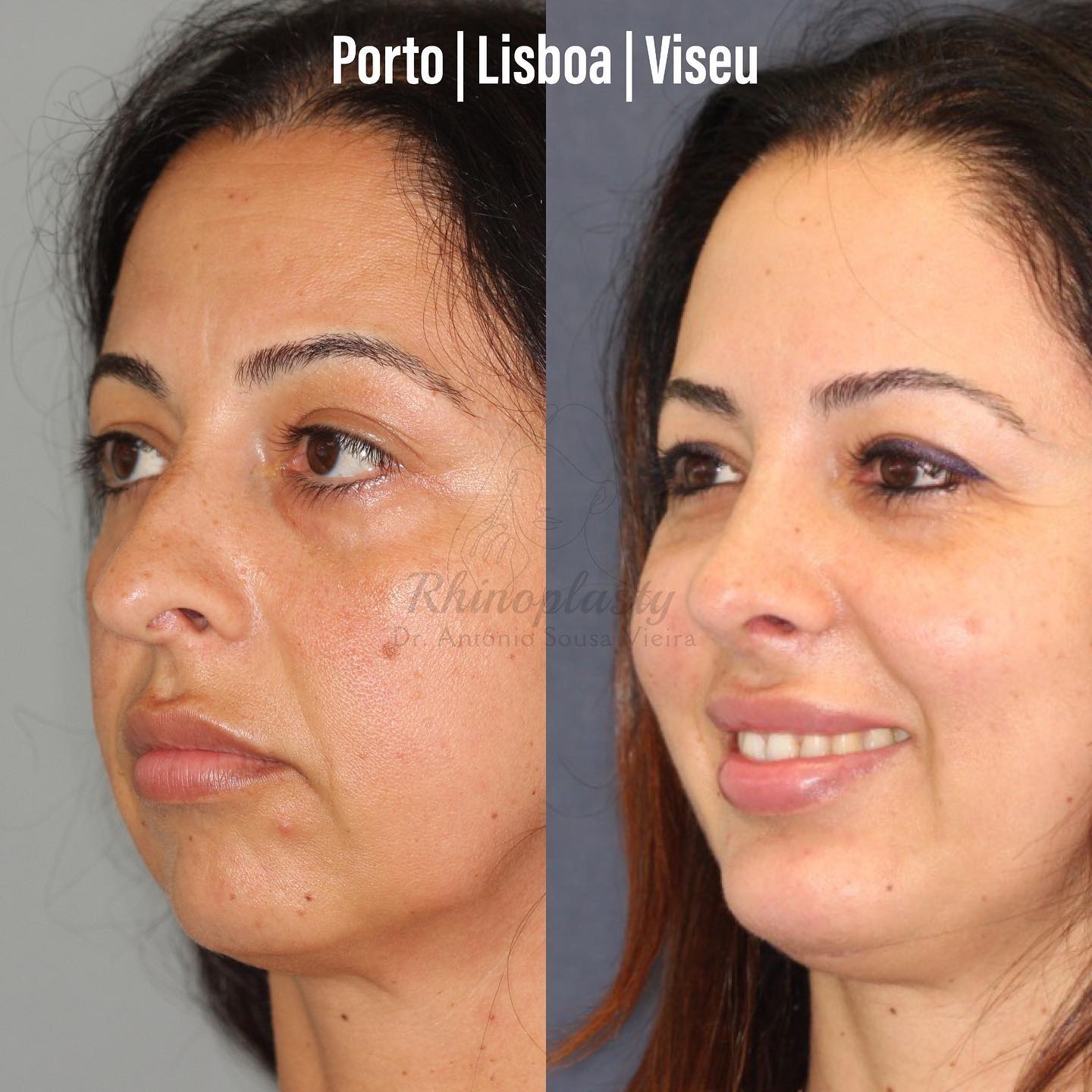 rinoplastia