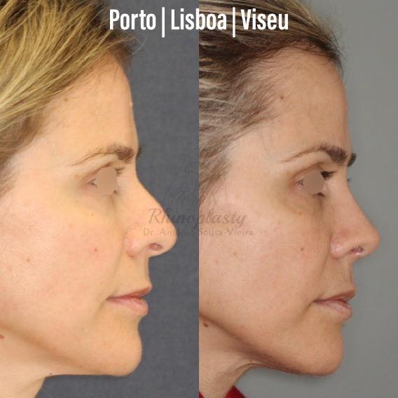 rinoplasrtia estruturada ultrassônica