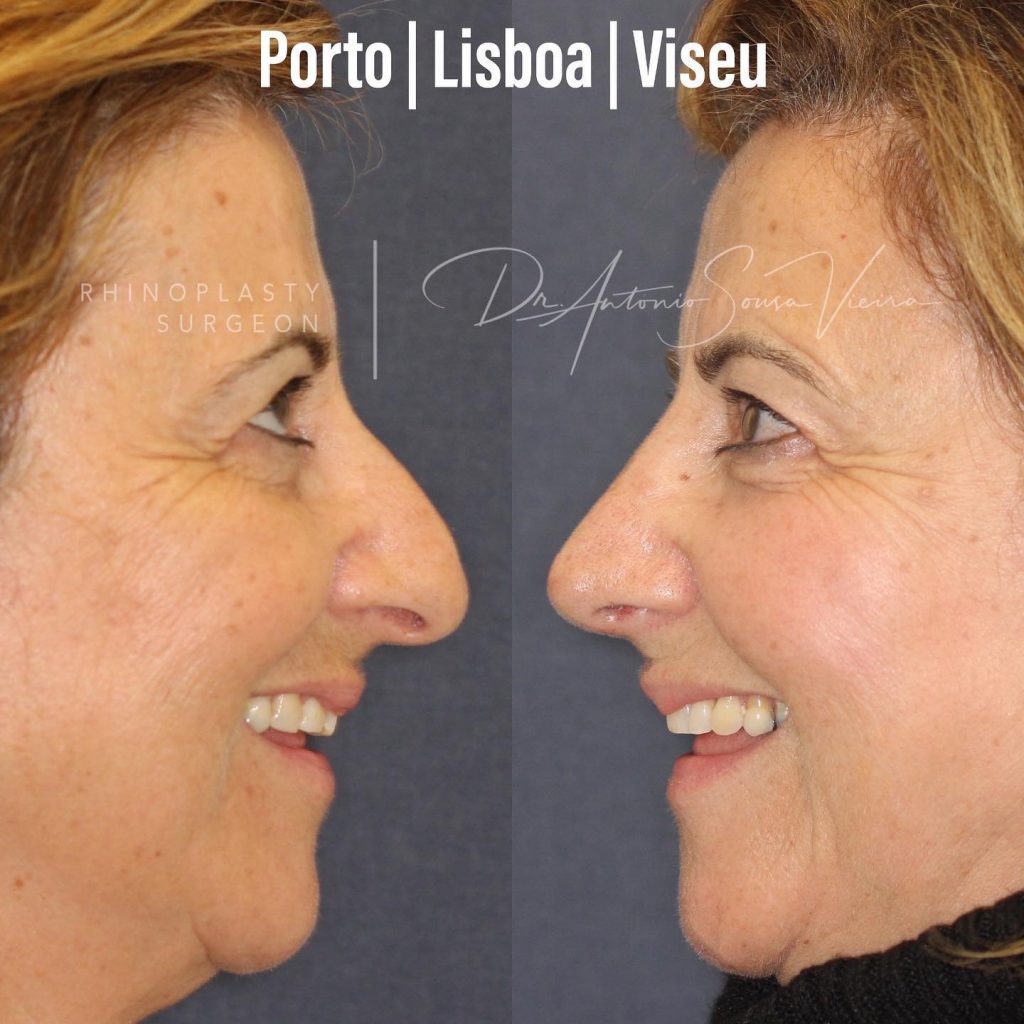 rinoplastia antes e depois