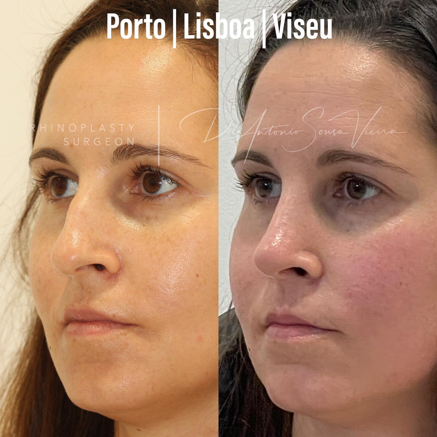 rinoplastia antes e depois