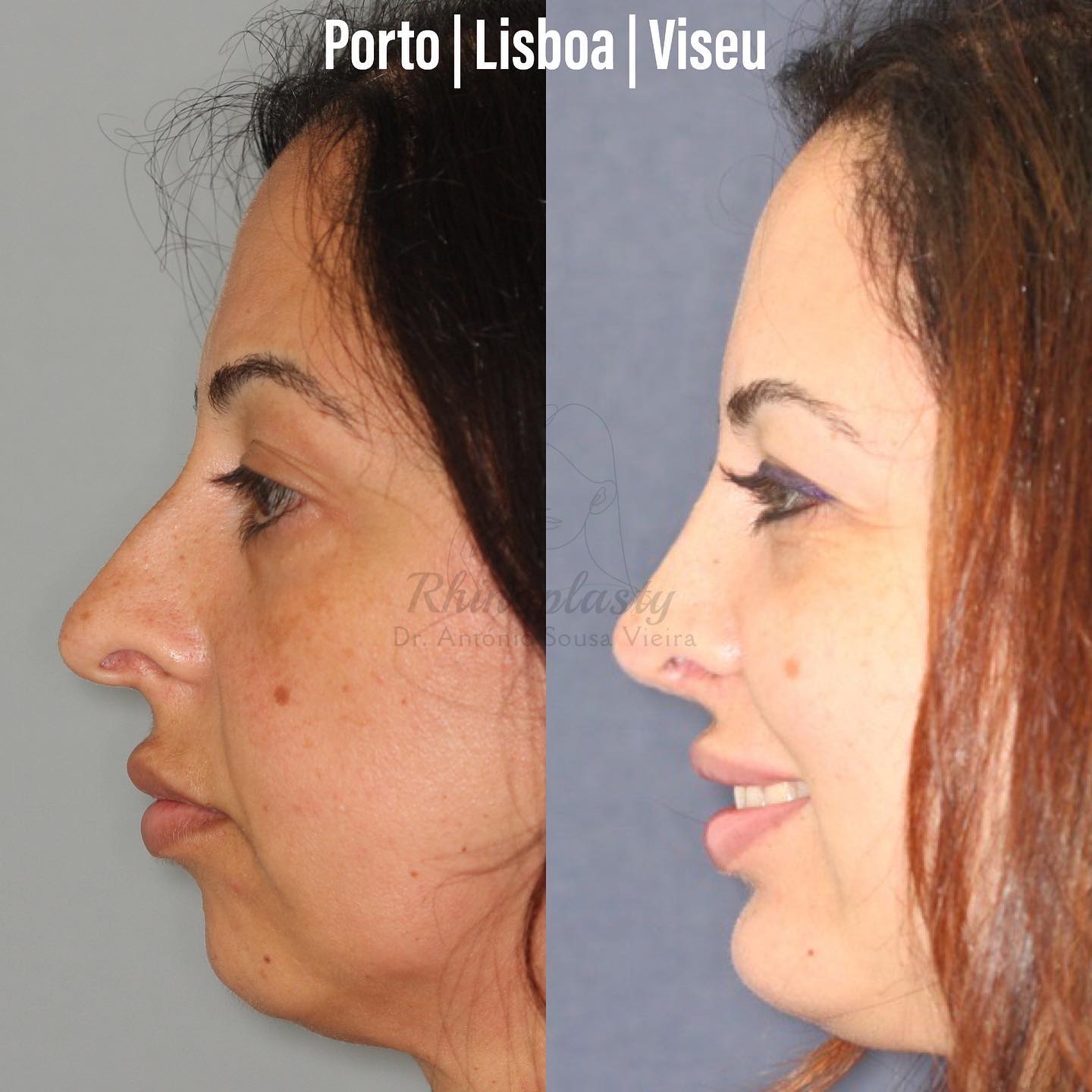 rinoplastia
