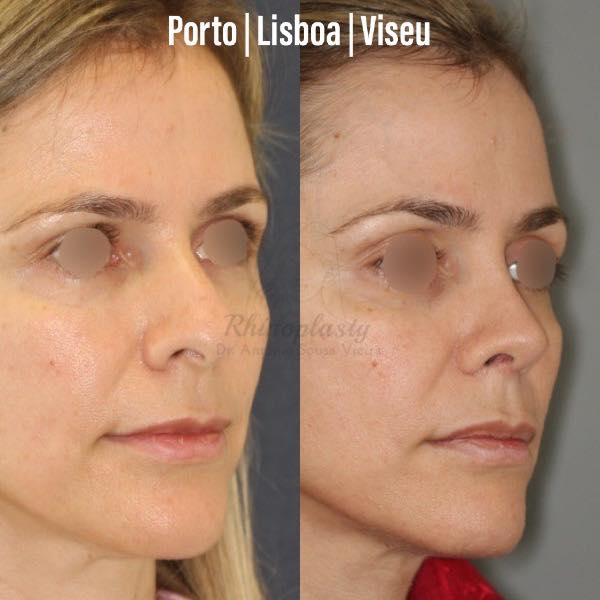 rinoplastia antes e depois