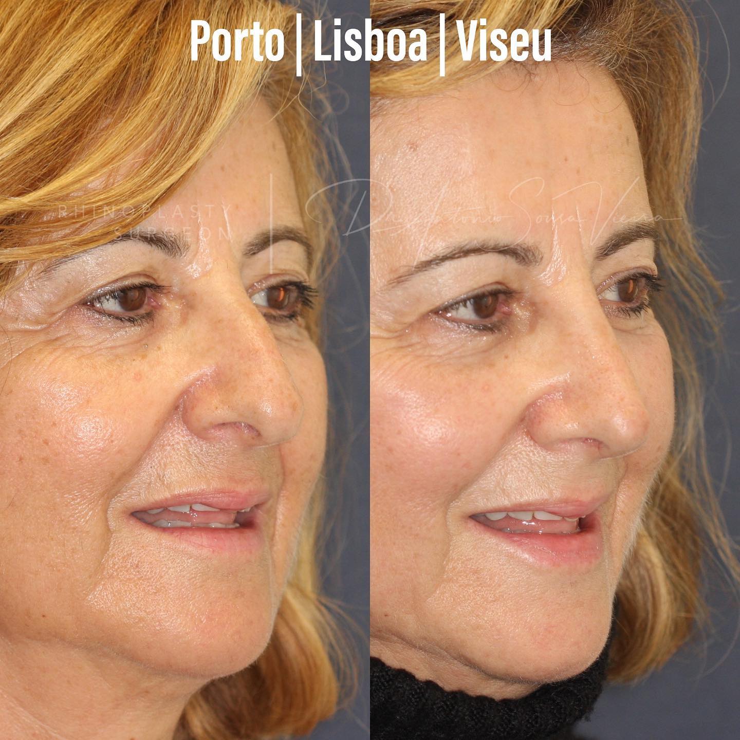rinoplastia