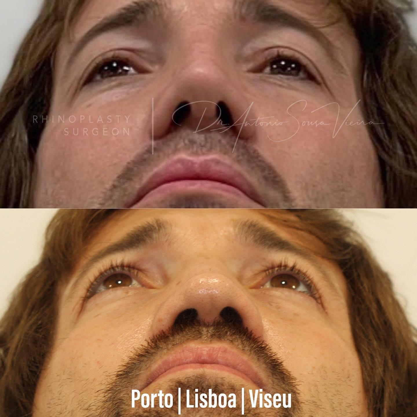 rinoplastia