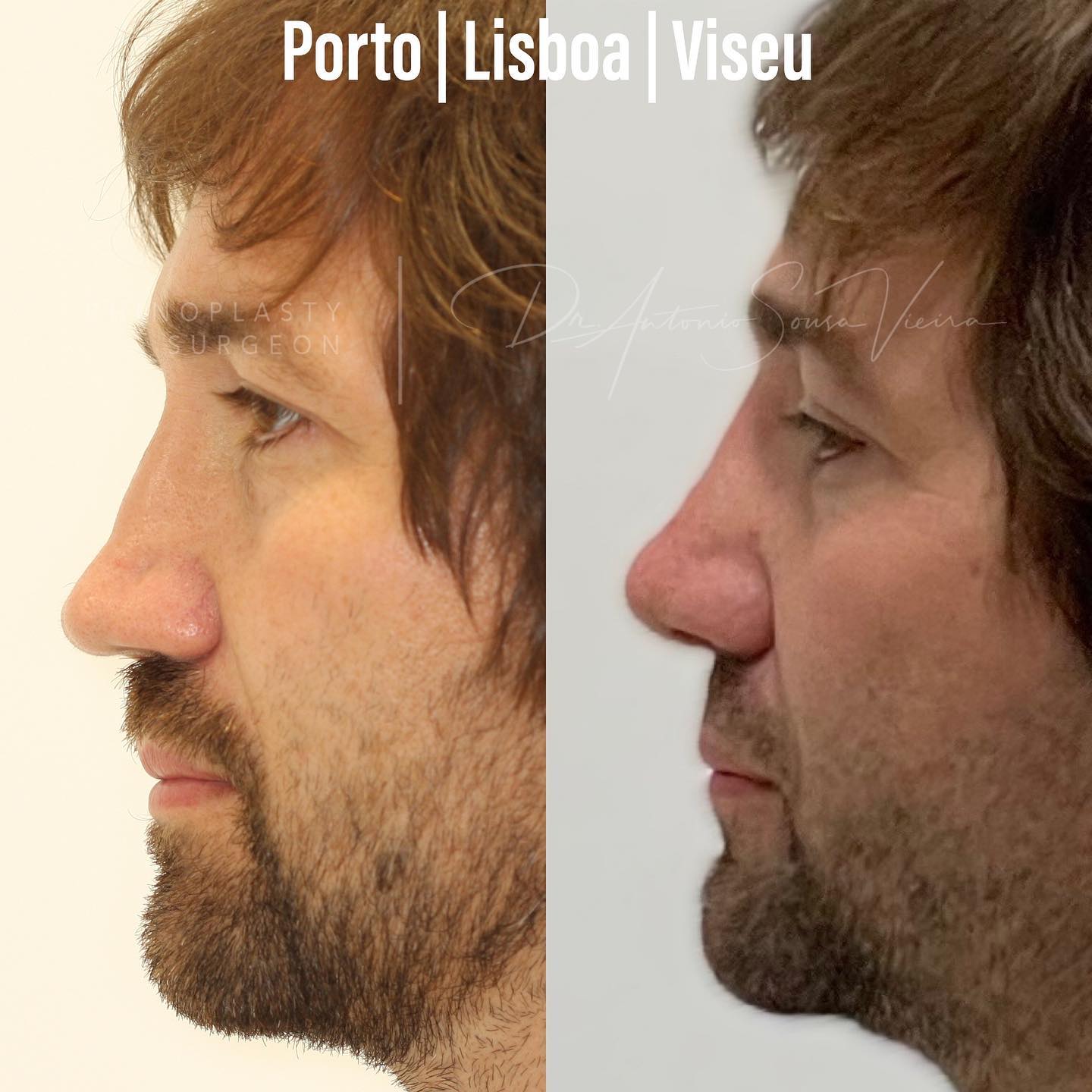 rinoplastia casos