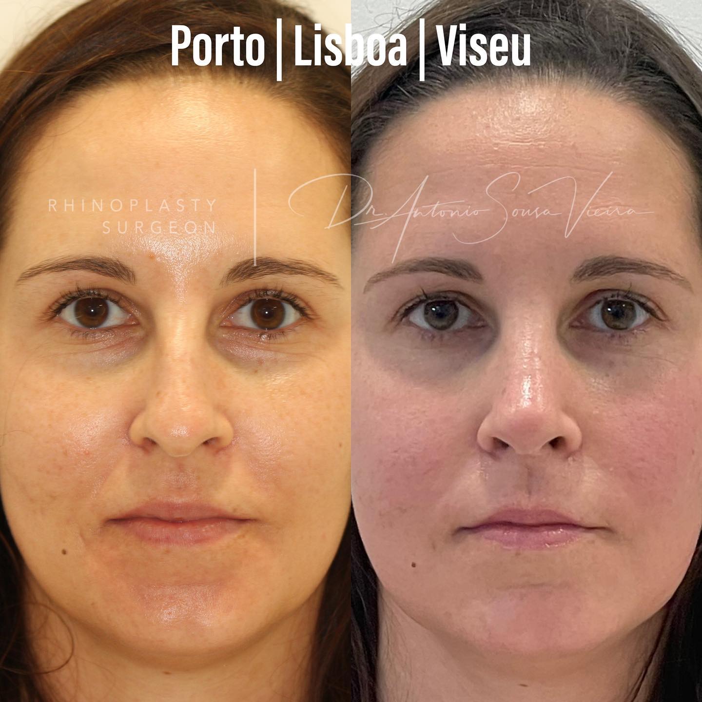 rinoplastia antes e depois