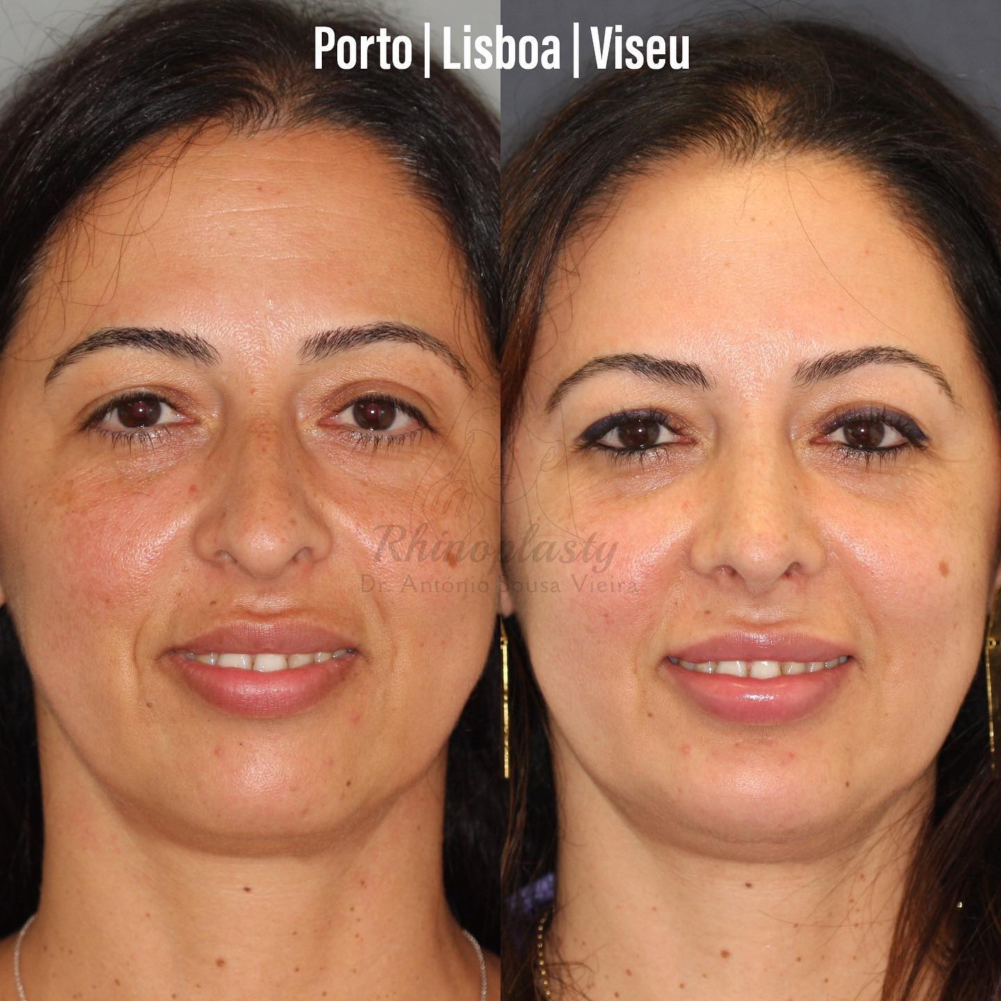 rinoplastia