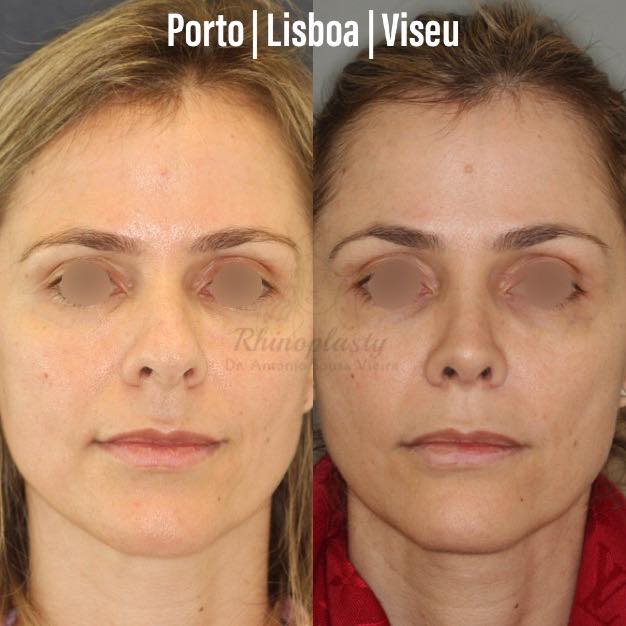 rinoplastia antes e depois