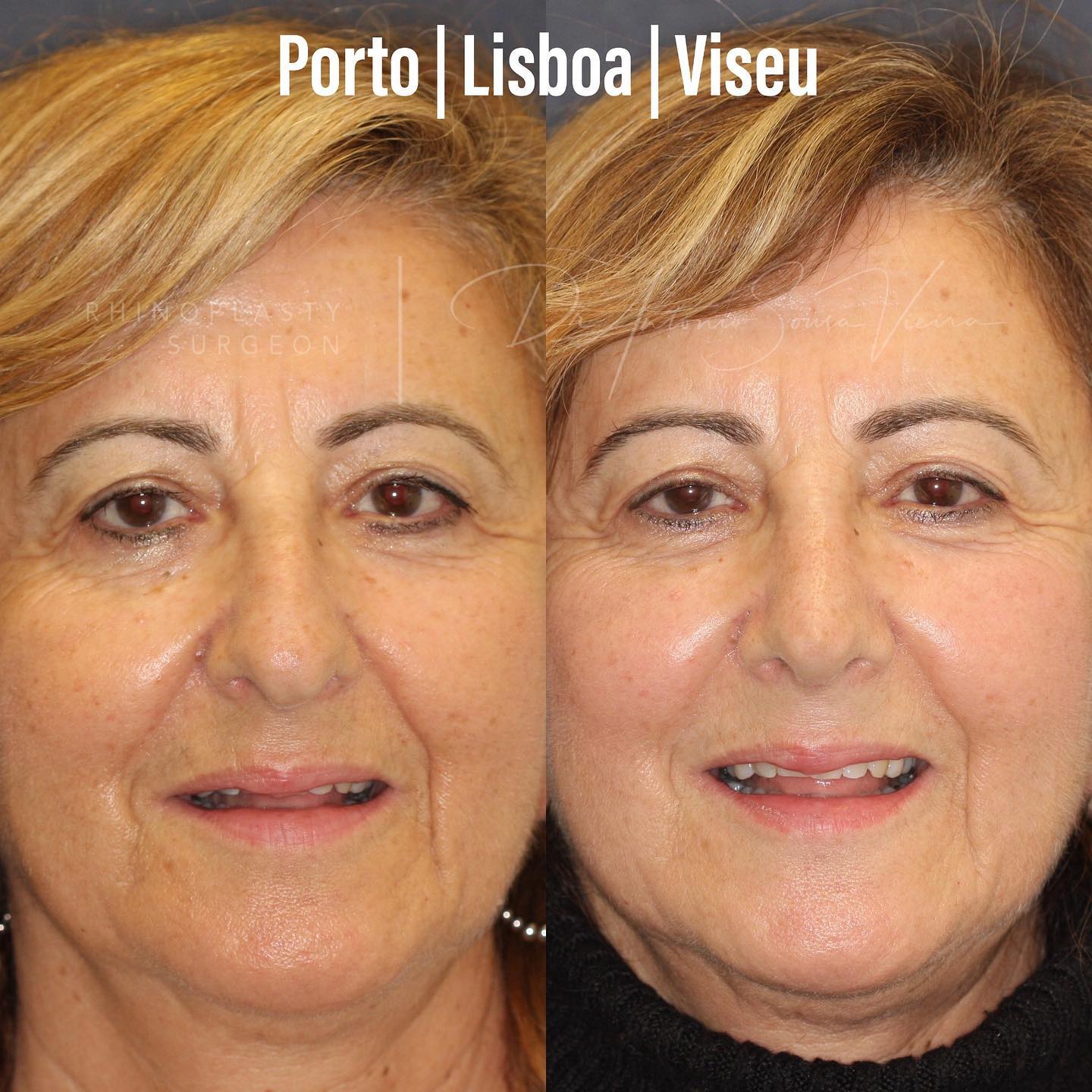 rinoplastia