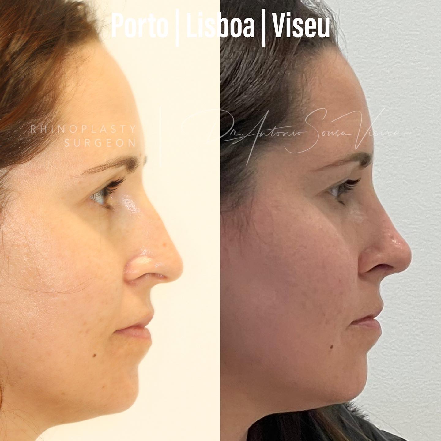 rinoplastia