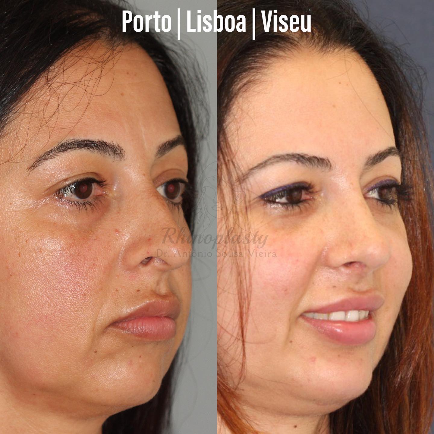 rinoplastia