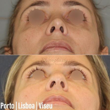 rinoplastia antes e depois