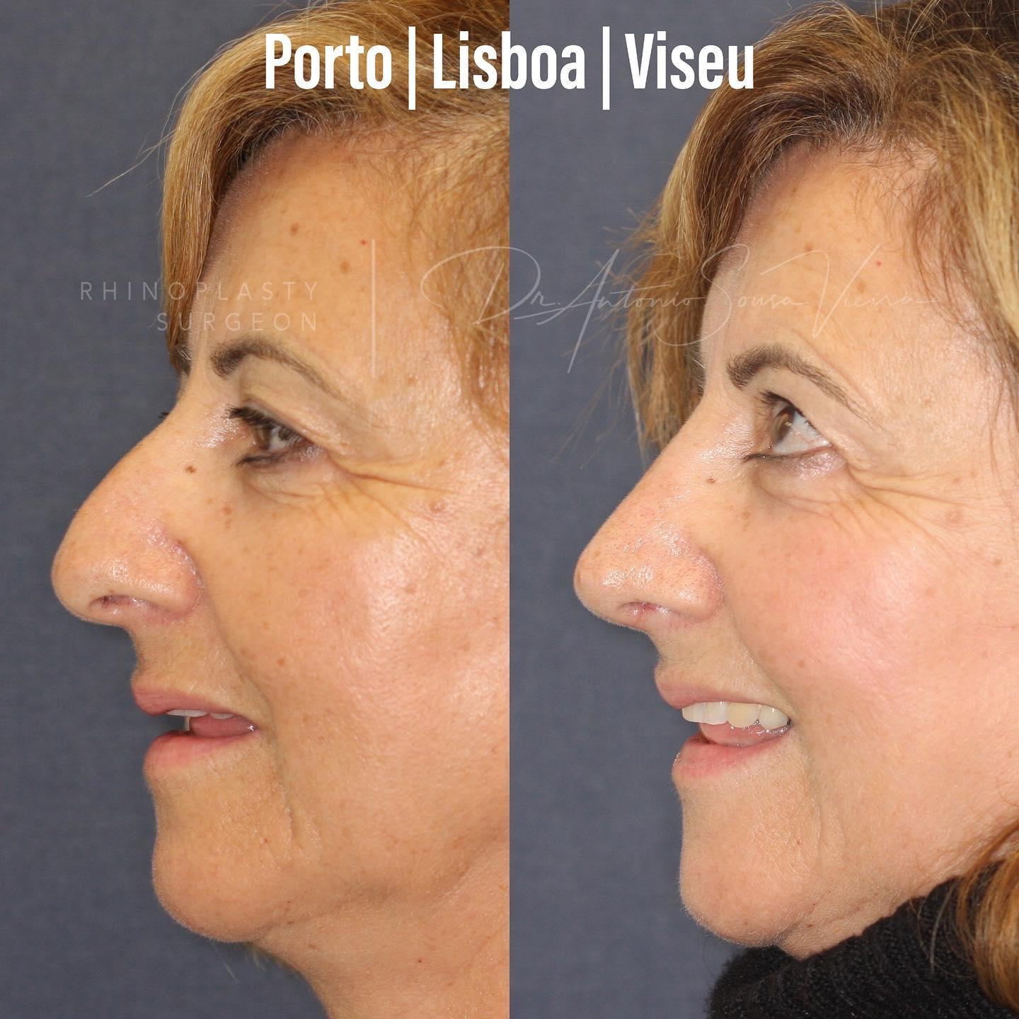 rinoplastia