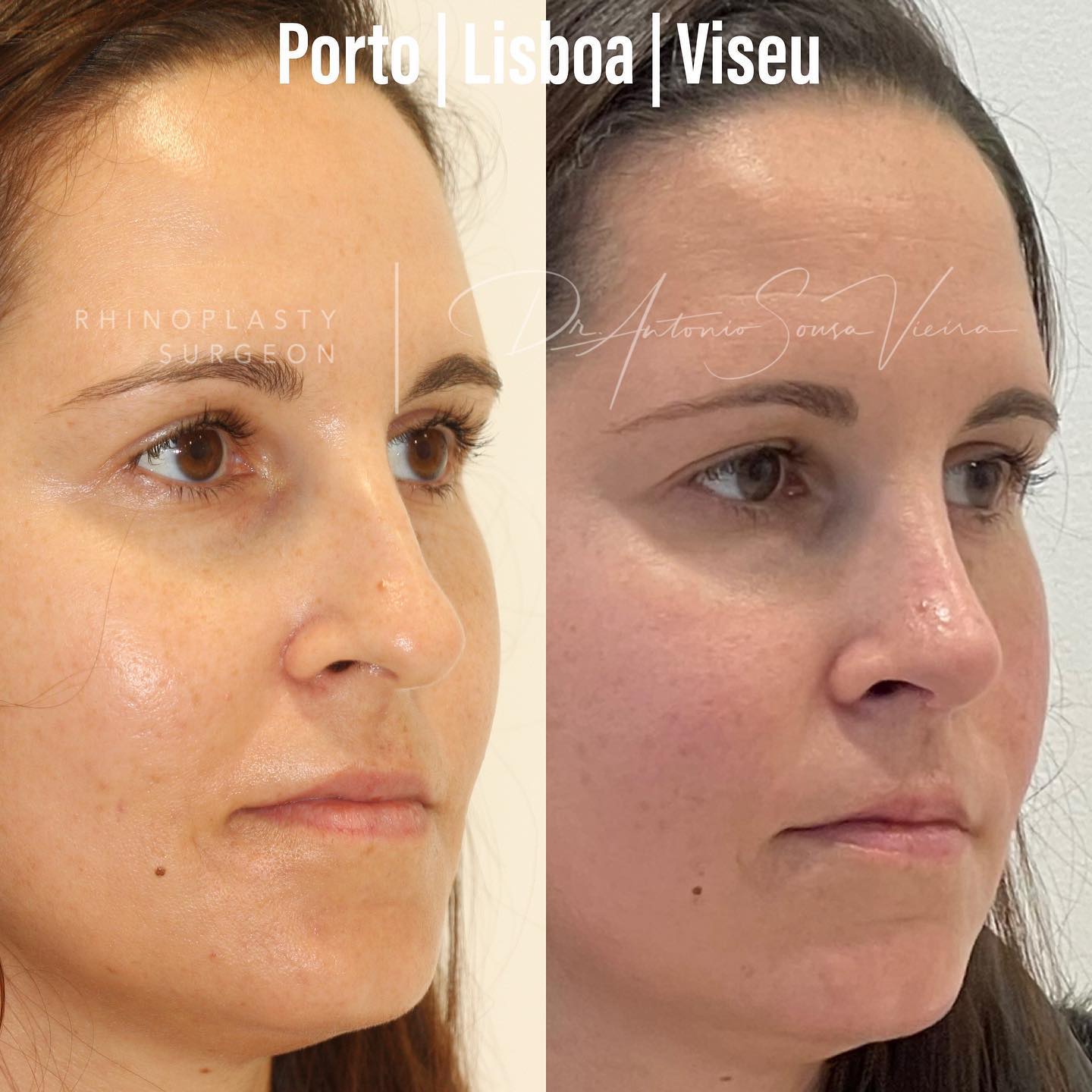 rinoplastia