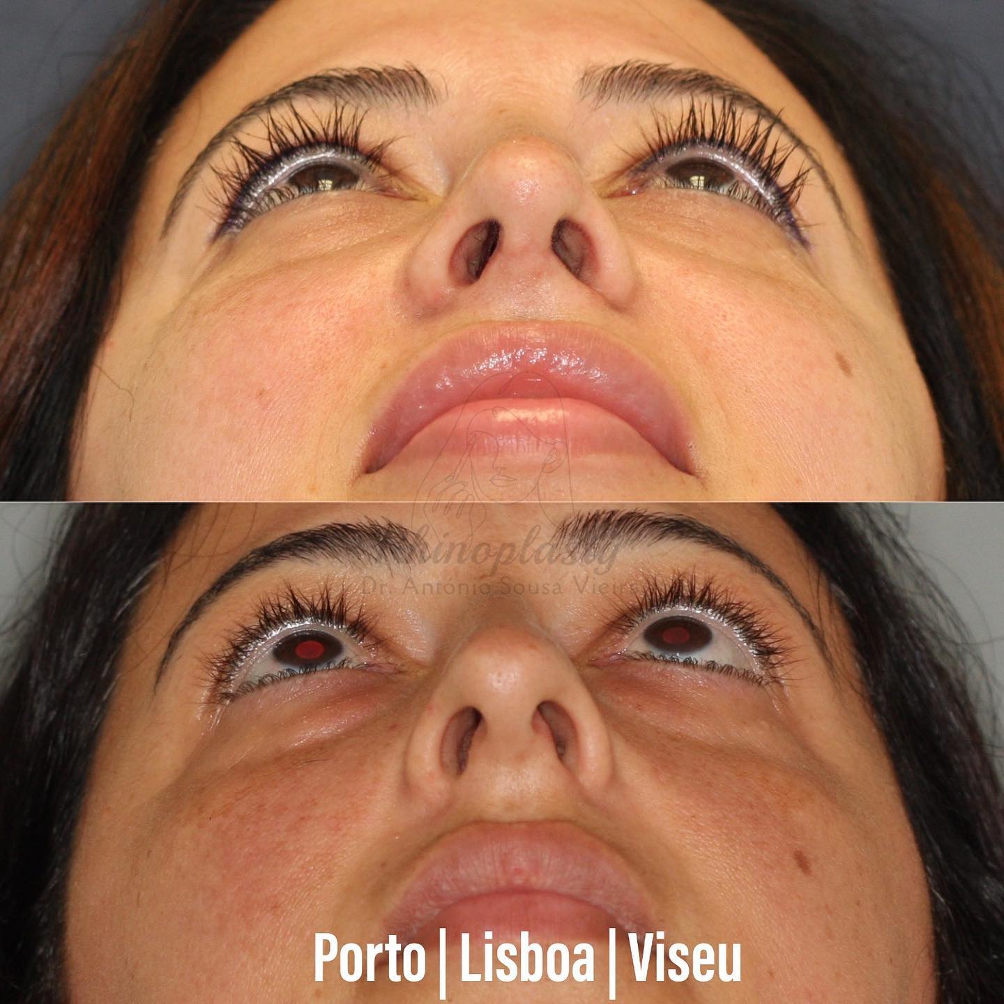 rinoplastia