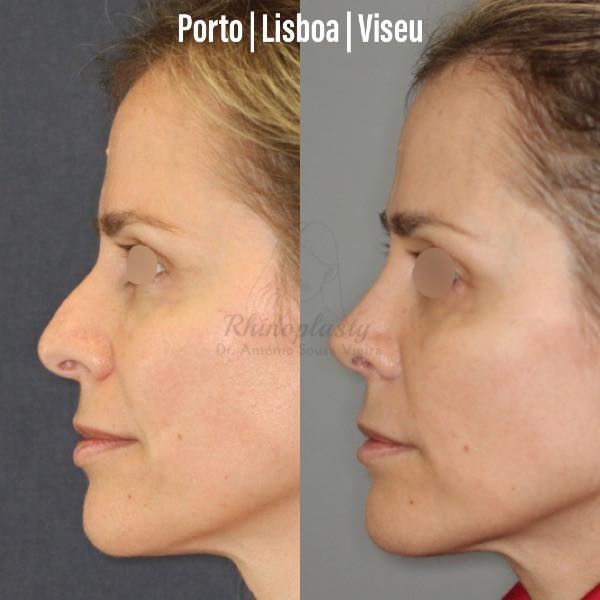 rinoplastia antes e depois