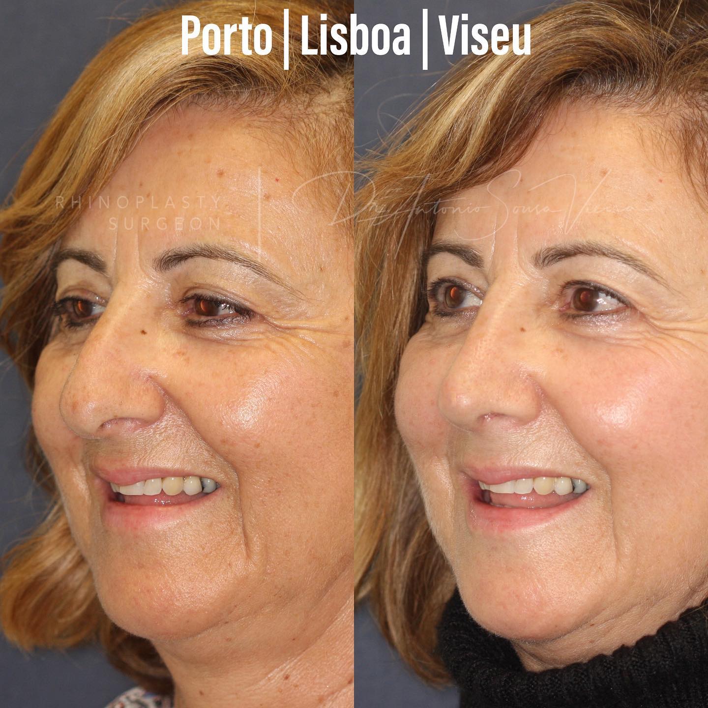 rinoplastia