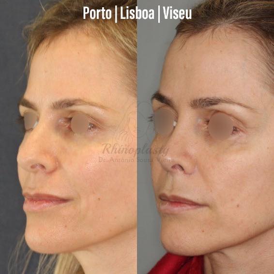 rinoplastia