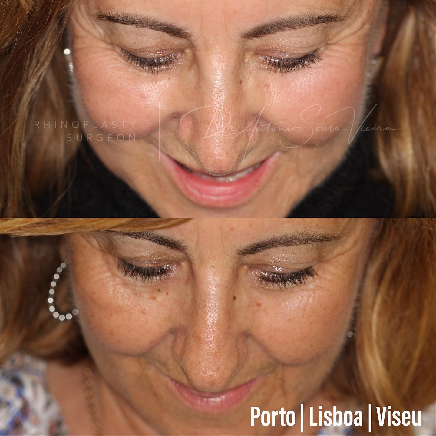 rinoplastia