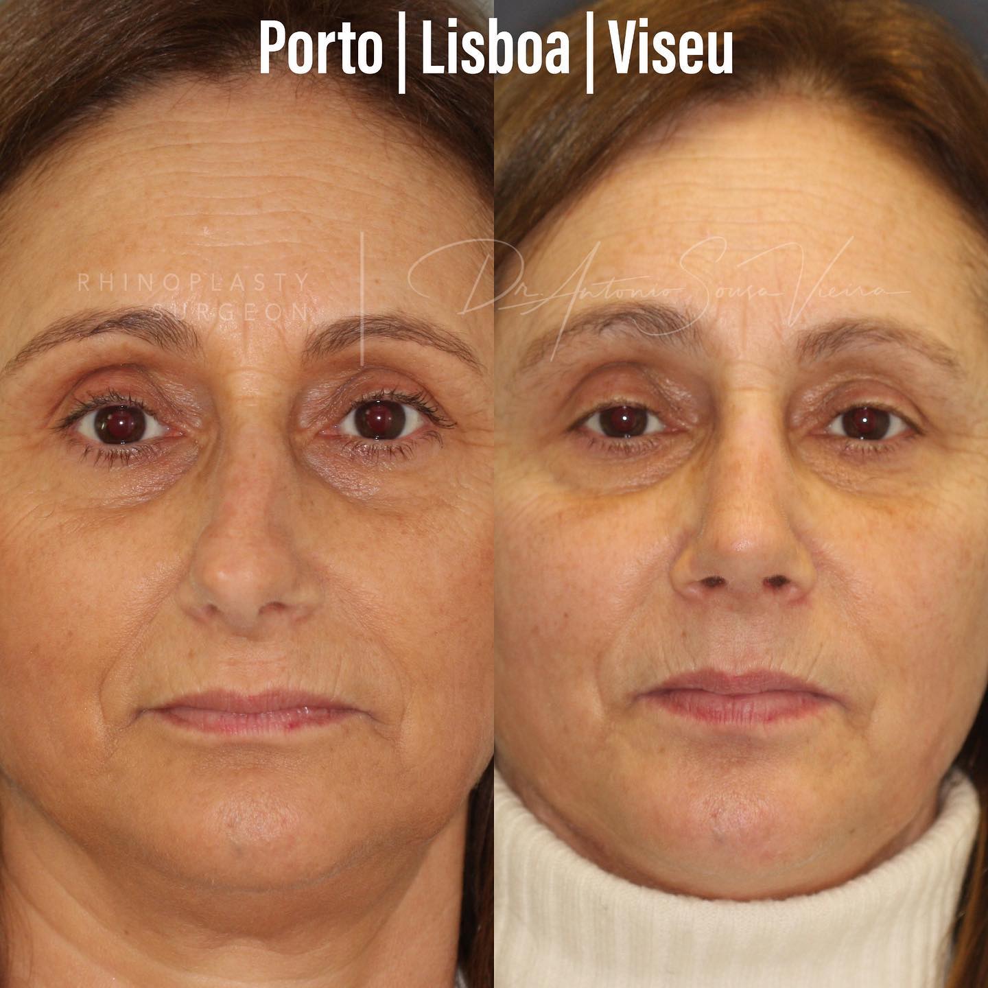 RINOPLASTIA DR SOUSA VIEIRA