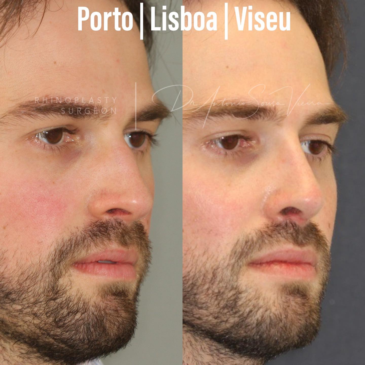 rinoplastia