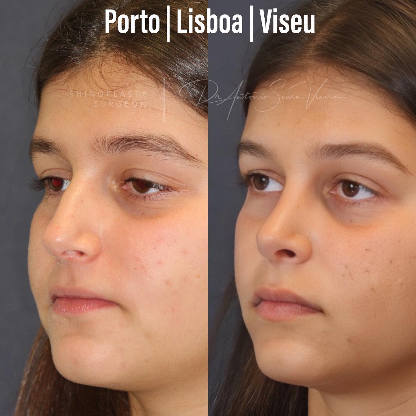 rinoplastia antes e depois