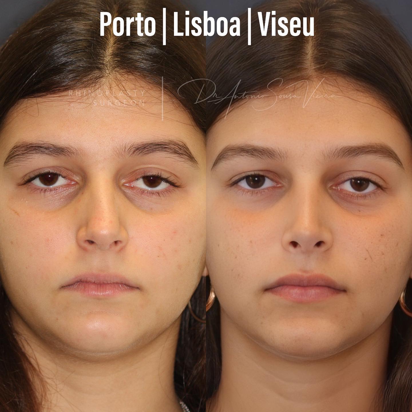 rinoplastia antes e depois